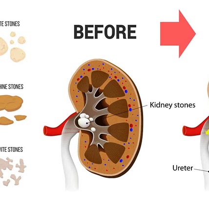 Low Oxalate Diet (bye bye kidney stones)